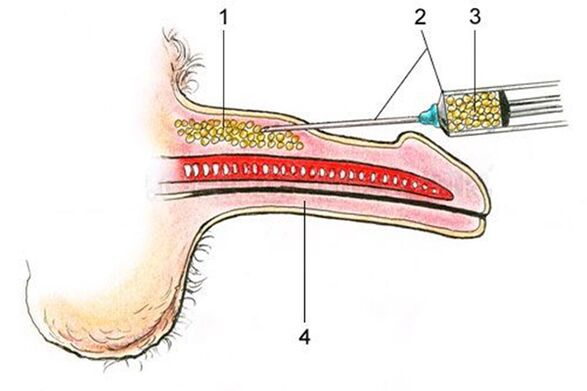 Lipofiling - unošenje masnog tkiva u osovinu penisa