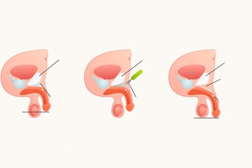 Ligamentomija povećati penis