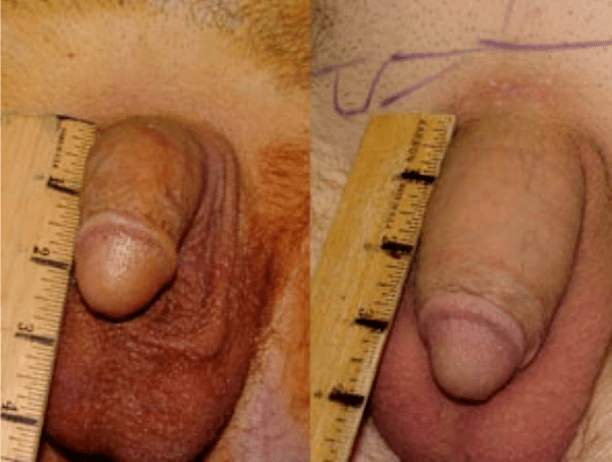 Prije i poslije lipofilinga i implantacije gela