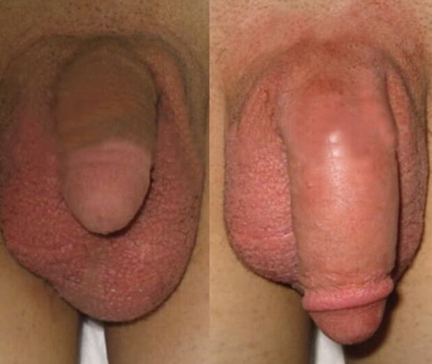 Rezultat ugradnje kolagene matrice u penis