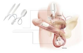 umetanje implantata u penis